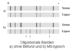 Oligoklonale Banden