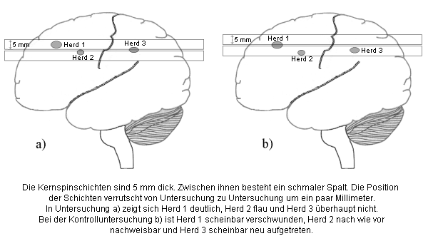 MRT-Schichten